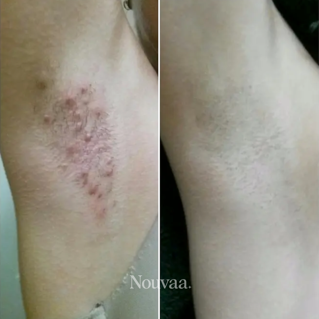 Nouvaa Razor - Bump-free shaving, smoothness that lasts
