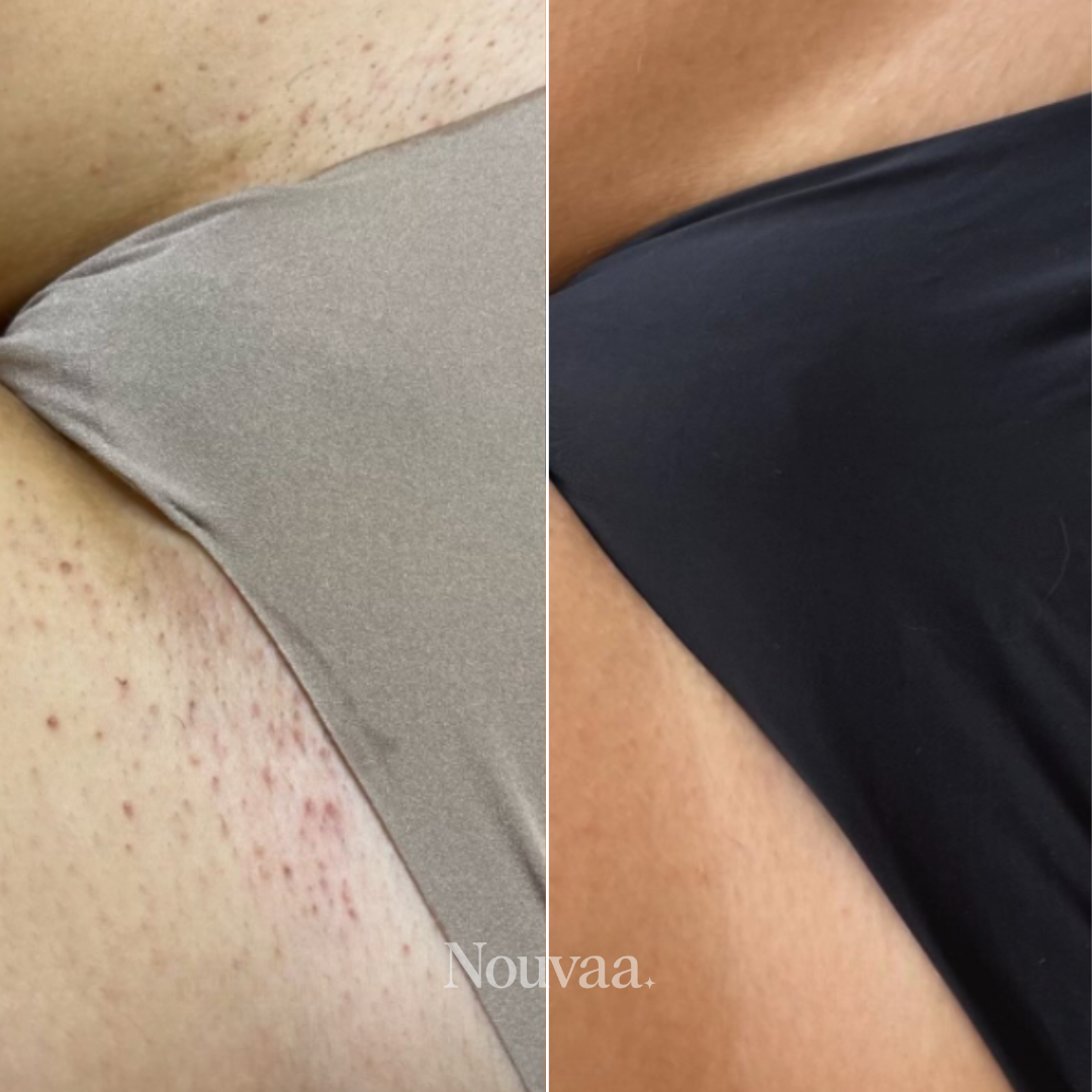 Nouvaa Razor - Bump-free shaving, smoothness that lasts